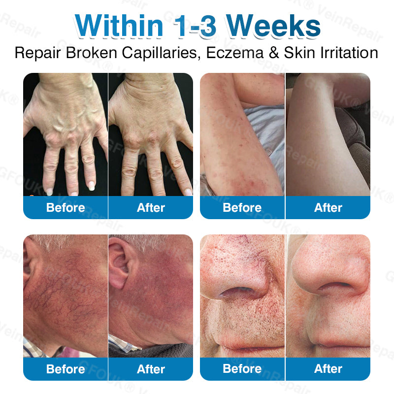 🇨🇦🏆✅️🏃GFOUK® VeinRepair Microneedle Patch Roll⚡Instant Relief, Long-Term Results