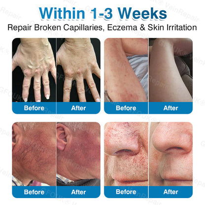 🇨🇦🏆✅️🏃GFOUK® VeinRepair Microneedle Patch Roll⚡Instant Relief, Long-Term Results