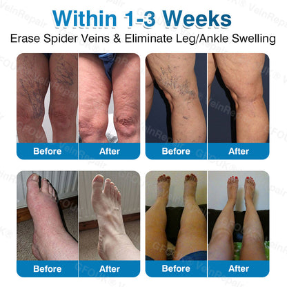 🇨🇦🏆✅️🏃GFOUK® VeinRepair Microneedle Patch Roll⚡Instant Relief, Long-Term Results