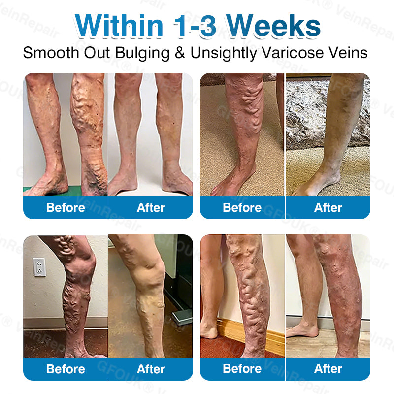 🇨🇦🏆✅️🏃GFOUK® VeinRepair Microneedle Patch Roll⚡Instant Relief, Long-Term Results